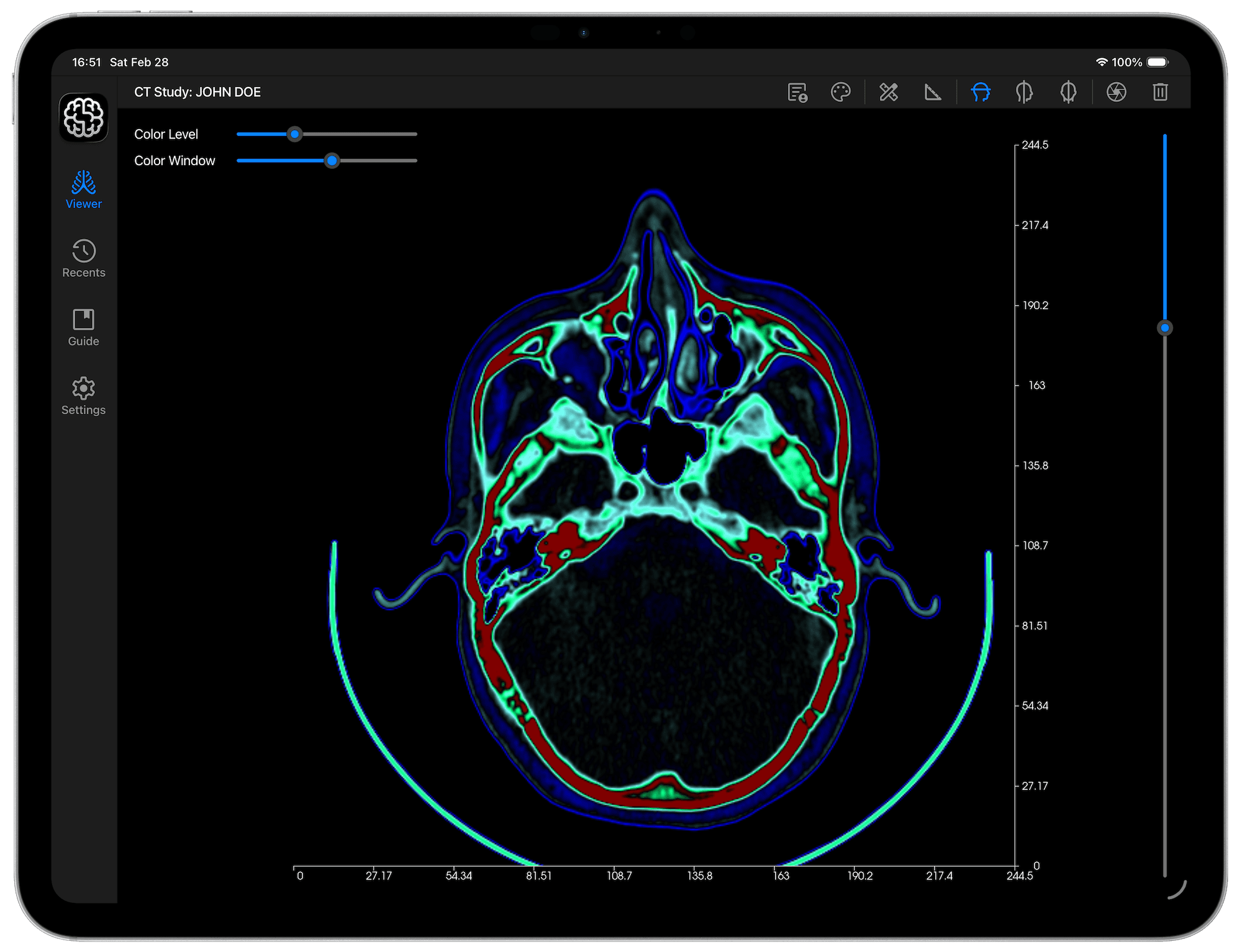 DICOM Vision Go on iPad - After Colormap is Applied