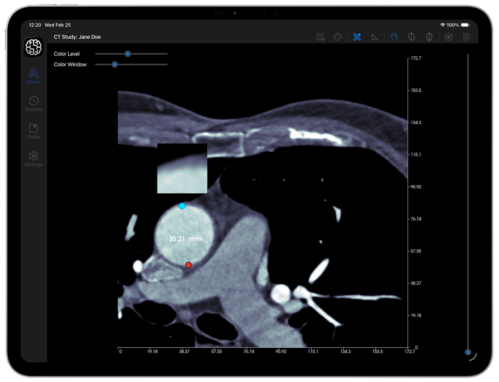 DICOM Vision Go on iPad - Distance Tool