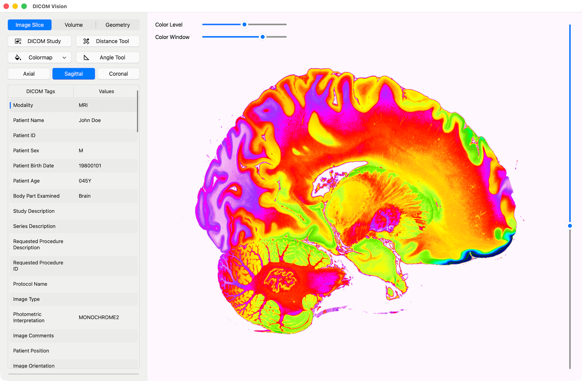 Sagittal Slice with Colormap - DICOM Vision
